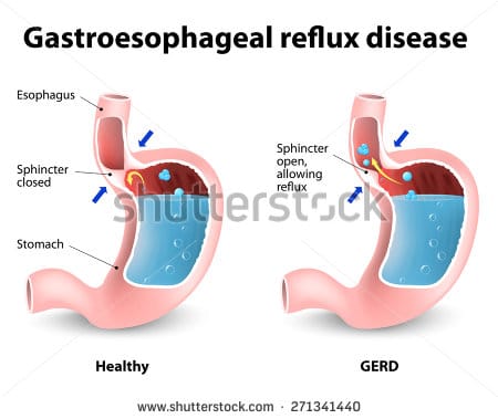 Obat-obatan untuk Mengatasi Gangguan Asam Lambung