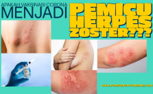 Efek Samping Booster Vaksin Pfizer BioNTech Muncul Infeksi Herpes Zoster